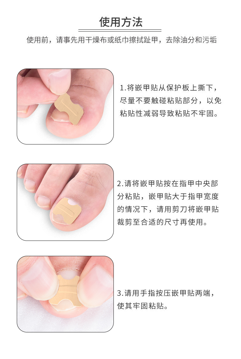 正甲贴甲沟嵌甲矫正器脚趾甲纠正指甲贴片长肉里修正甲神器拉拉炎