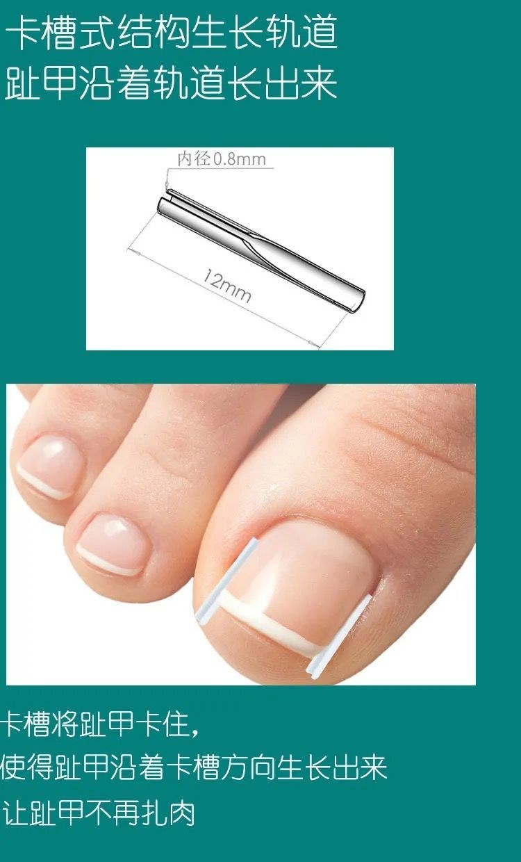甲沟炎神器指甲矫正器嵌甲专用隔离填充垫片脚趾甲往肉里长纠正甲
